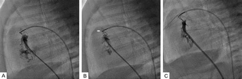 Optimal Management Of Pulmonary Atresia With Intact Ventricular Septum