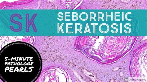 Seborrheic Keratosis Histology