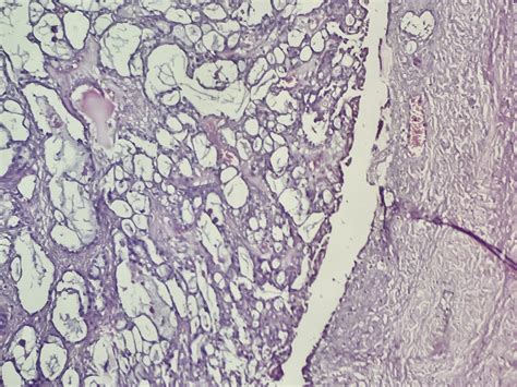 CLEAR CELL CARCINOMA OVARY Histopathology Guru