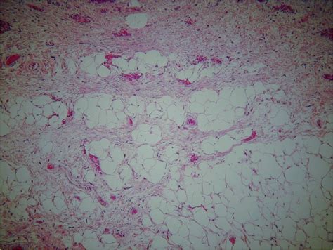 Liposarcoma Well Differentiated Liposrcoma Low Grade Liposarcoma