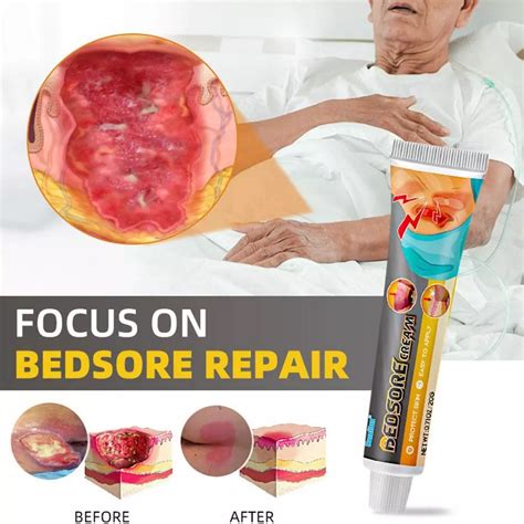 Bed Sore Cream Bedsore Ointment Bed Sores Treatment Fast, 47% OFF