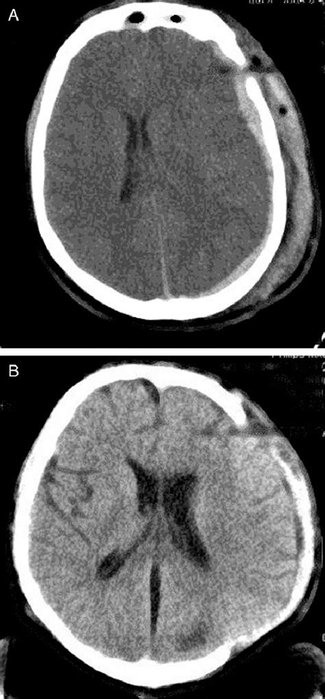 A Axial Ct Scan Showing Left Hemispheric Brain Edema Associated With A Download Scientific