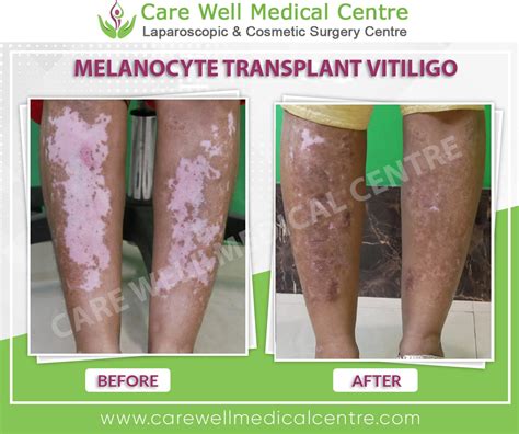 Treatments Before And After Results Gallery Care Well Medical Centre