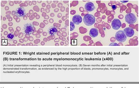 Figure 1 From Coexistence Of Chronic Myelomonocytic Leukemia And