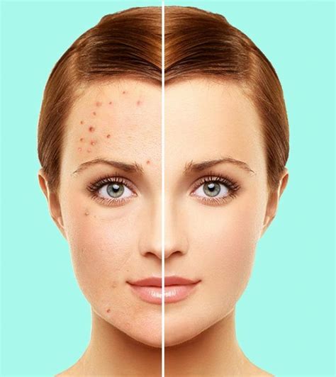 10 Home Remedies For Rosacea That Prevent Redness On The Skin Artofit