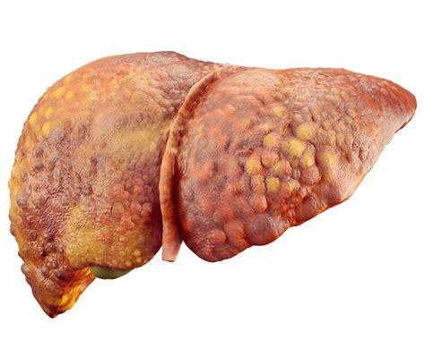 Comprehensive Guide To Liver Disease Gidoc Cpt