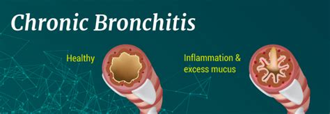 Best Antibiotic For Bronchitis And Sinus Infection Syrup Tablets