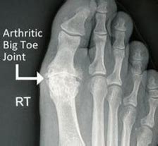 Big toe (1st MTP joint) Arthritis - Orthopaedics 360