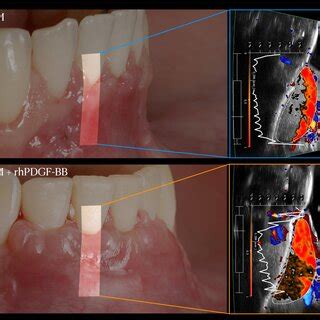 Ultrasonographic dynamic tissue perfusion assessment performed 2 weeks... | Download Scientific ...