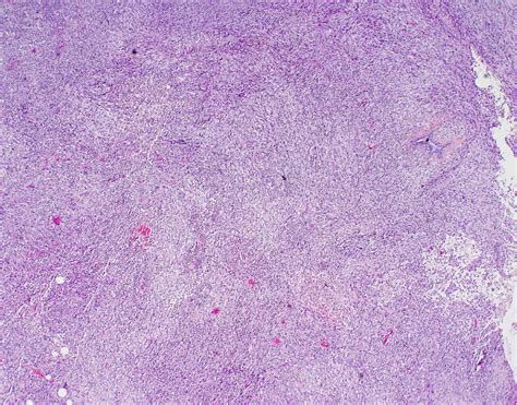 Spindle Cell Metaplastic Carcinoma Breast Bosnianpathology