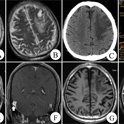 The T1 Weighted Magnetic Resonance Images A The T2 Weighted Magnetic Download Scientific