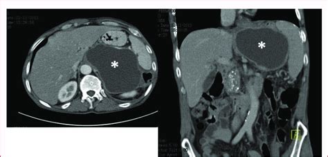 Abdominal CT scan showing a pancreatic pseudocyst of 11 cm × 8 cm... | Download Scientific Diagram