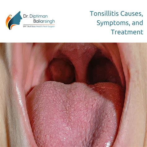 Tonsillitis Causes Symptoms And Treatment