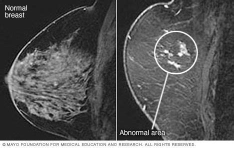 Breast MRI - Drugs.com