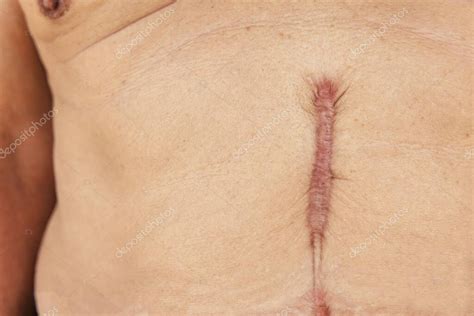 Close Up Of Scar Caused By Abdominal Aorta Surgery In Elderly Men