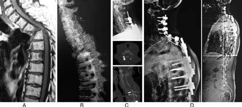 Angular Kyphosis Due To Pathological Fracture Of T3 After Multiple