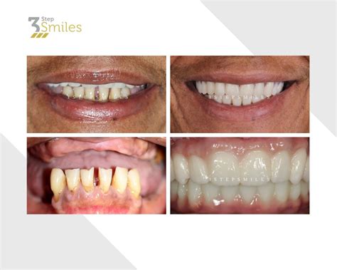 Revolutionary Dental Implants Glasgow 3 Step Smiles Dental Clinic