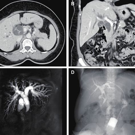 Preoperative Imaging Revealed Biliary Obstruction A B Abdominal