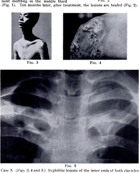 Figure 5 From Osteolytic Bone Syphilis Semantic Scholar