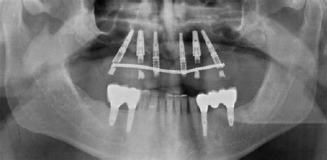 Ortopantomografía o Radiografía Panorámica qué es