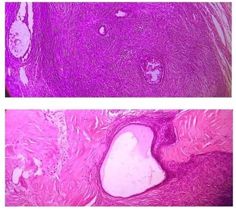 Sections Of Right Ovary Showing Extensive Areas Of Fibrosis Necrosis