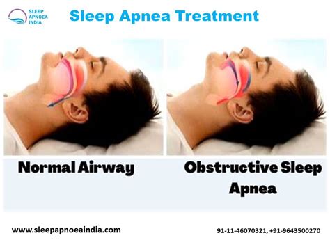 Sleep Apnea Treatment - SC Classifieds