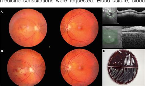 Figure From Unusual Endophthalmitis With Macular Infarction