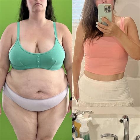 Before And After 1 Year Results Rliraglutide