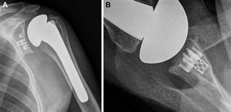 Typical Anteroposterior A And Axillary Lateral B Radiographs Of An