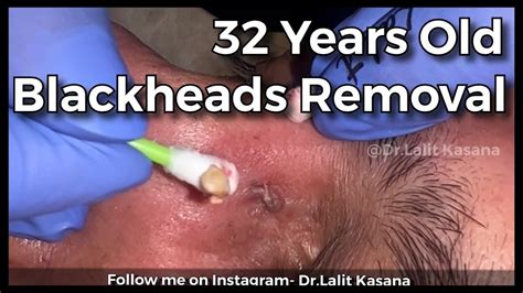 35 YEARS OLD DEEP BLACKHEAD REMOVAL BY DR LALIT KASANA NEW BLACKHEAD