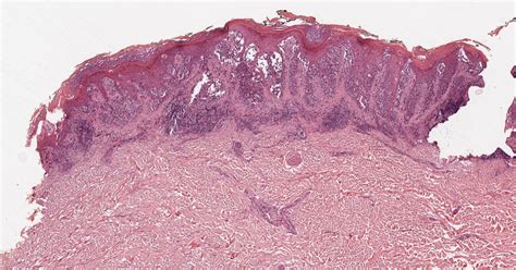 Differential Diagnosis In Dermatopathology Pagetoid Spread Of Cells Or