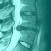 Ligamentum flavum hypertrophy Symptoms, Causes, Radiology, Treatment - Health Care Tips and ...