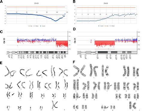 Detection Of Complex Deletions In Chromosomes 13 And 21 In A Fetus By