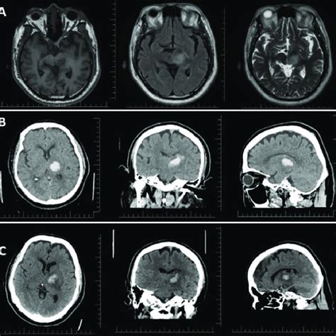 A Preoperative Axial T Weighted Precontrast Left T Flair