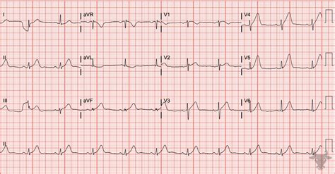 Hyperacute T Waves Ecg Stampede