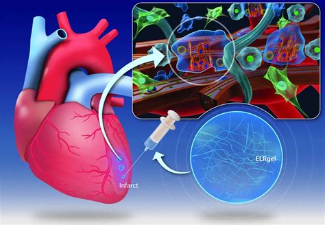 Hydrogel could repair heart attack damage