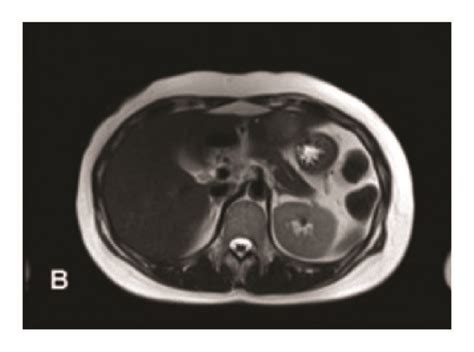 Abdominal Magnetic Resonance Imaging Mri Findings A T1 Weighted