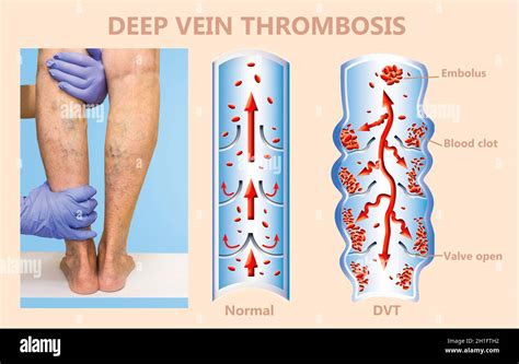 deep vein thrombosis  blood clots embolus structure  normal