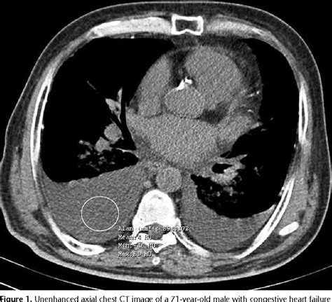 Pleural Effusion On CT Scan