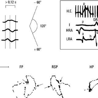 Above: P wave ± morphology in I, II, and III typical of third-degree ...