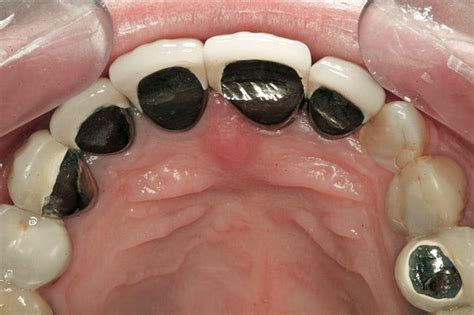 The Pros And Cons Of Metal Ceramic Crowns By Dentcaredental Medium