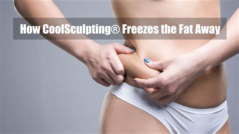 How Coolsculpting® Freezes The Fat Away Youtube