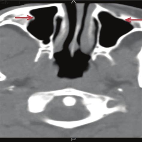 Apparent left maxillary antrostomy that was seen clinically | Download ...