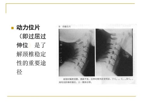 颈椎x线诊断 平高医院康复科 赵铎 Ppt Download