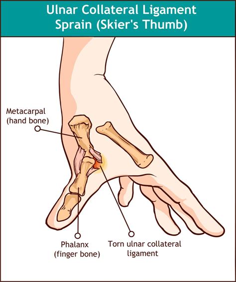 Thumb Ligament Injury Ladan Hajipour Hand And Wrist Surgeon