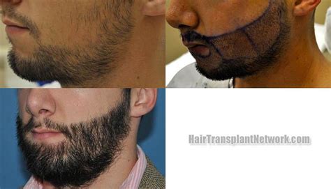 Dr Mike Vories Hair Transplant Surgery Before And After Result