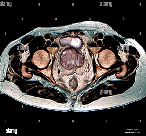 Benign Prostatic Hyperplasia Magnetic Resonance Imaging Mri Scan Of An Axial Section Through