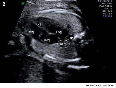 Fetal Double Aortic Arch