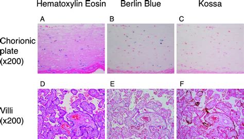 Placental histology. Hematoxylin-eosin staining (A, D). Hemosiderin ...