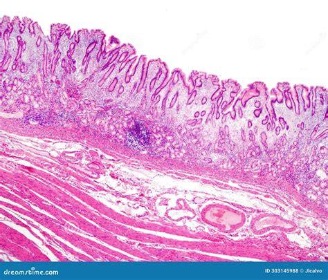 human stomach chronic gastritis stock photo image  stomach